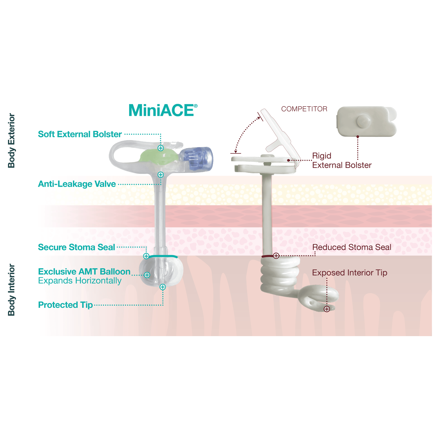 AMT MiniACE® Irrigation Set, 30cm Right Angle Irrigation Set - Anjelstore