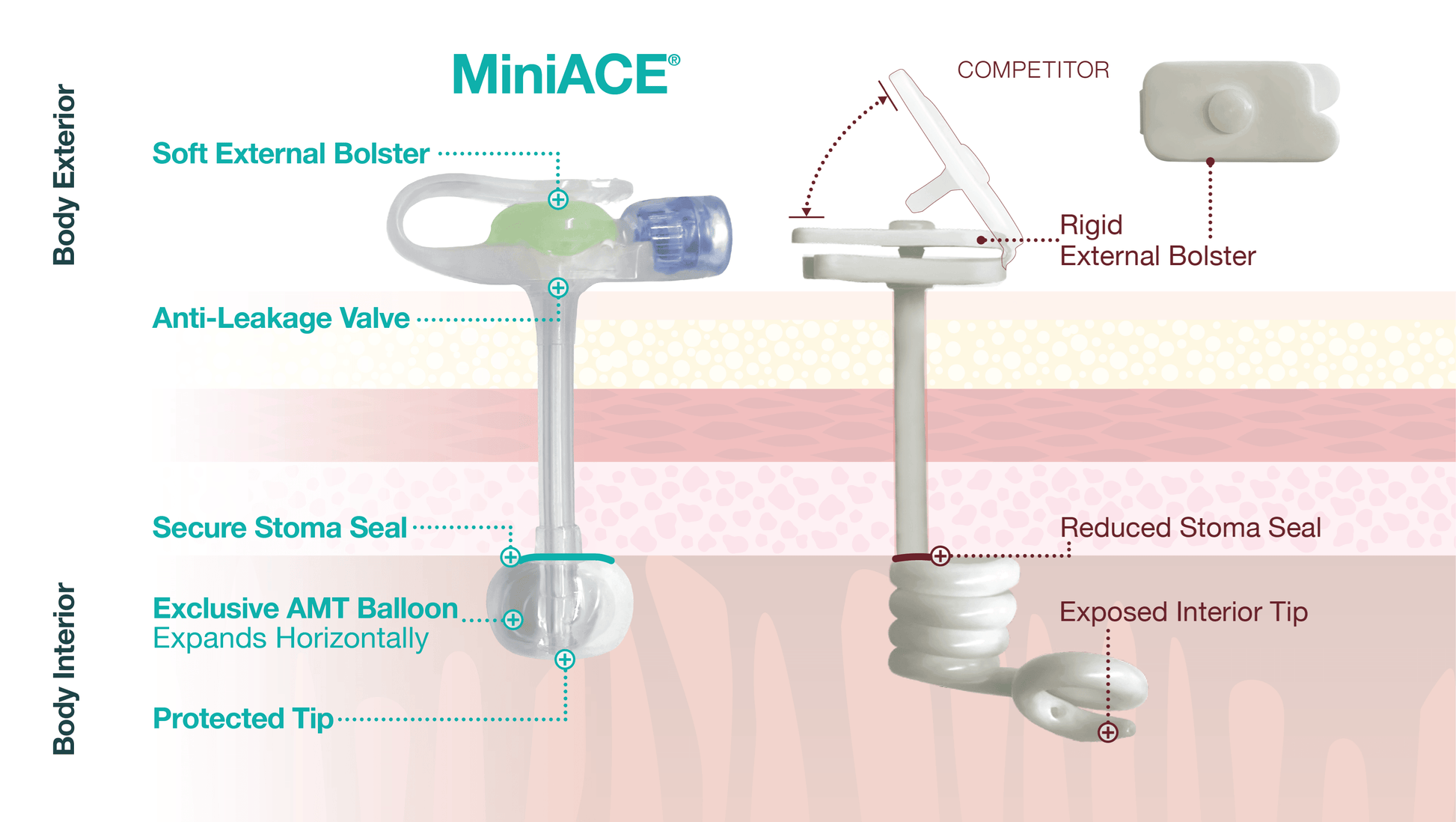 AMT MiniACE® Irrigation Set, 30cm Right Angle Irrigation Set - Anjelstore 